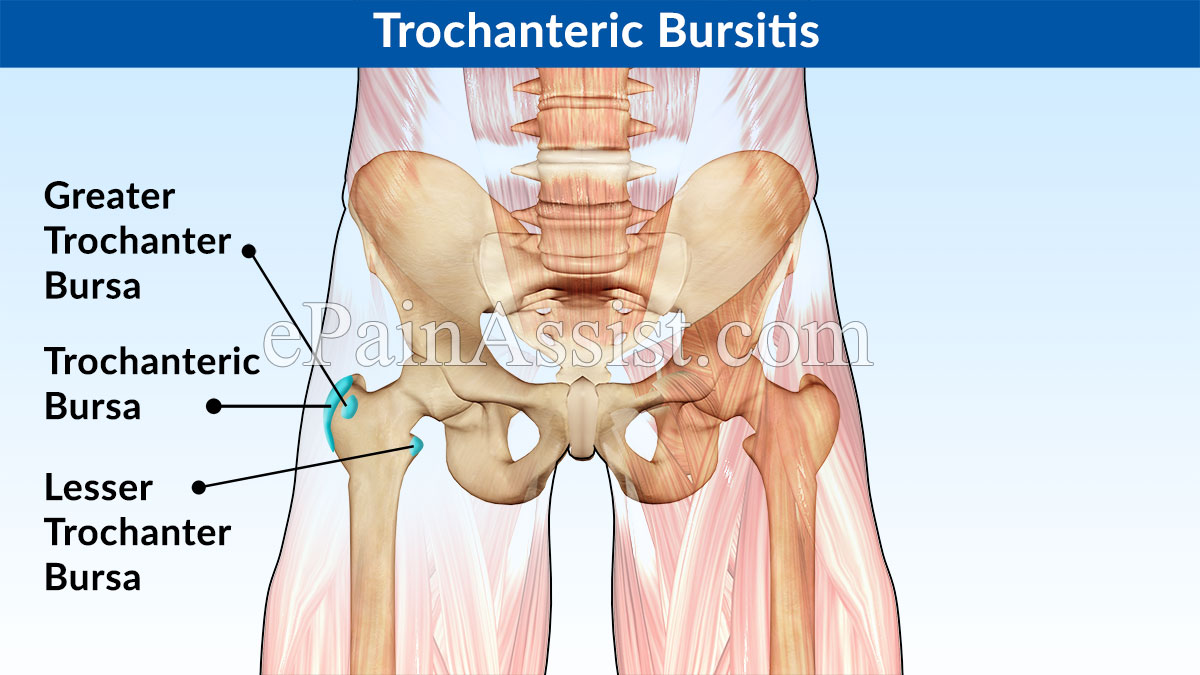 Trochanteric Bursitis Treatment Beverly Hills Ca