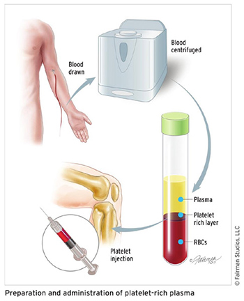 Platelet-Rich Plasma (PRP) Injections - Soma Orthopedics ...